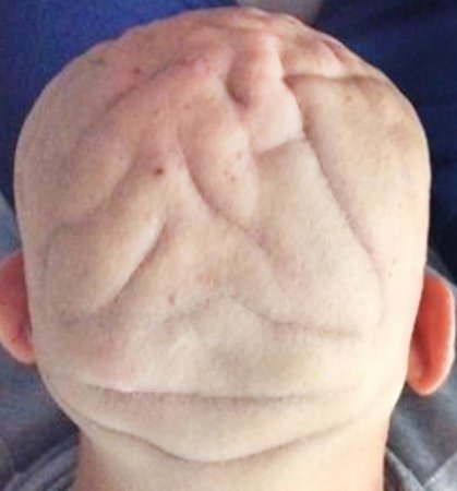 37-ամյա իտալացու գլուխը ձեւախեղվել է օրգանիզմում աճի հորմոնի ավելցուկի պատճառով
